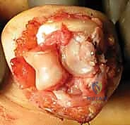 Surgical technique step for Open Reduction and Internal Fixation of Proximal Interphalangeal Joint Fracture-Dislocations