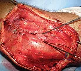 Illustration of radial head arthroplasty - Dr. Mohammed Hutaif