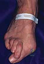 Illustration of rheumatoid forefoot reconstruction - Dr. Mohammed Hutaif