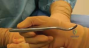صورة توضيحية لـ إعادة بناء مقدمة القدم الروماتويدية: دليل شامل للمرضى مع الأستاذ الدكتور محمد هطيف