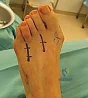صورة توضيحية لـ إعادة بناء مقدمة القدم الروماتويدية: دليل شامل للمرضى مع الأستاذ الدكتور محمد هطيف