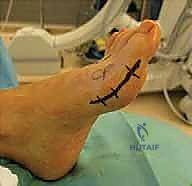 صورة توضيحية لـ إعادة بناء مقدمة القدم الروماتويدية: دليل شامل للمرضى مع الأستاذ الدكتور محمد هطيف