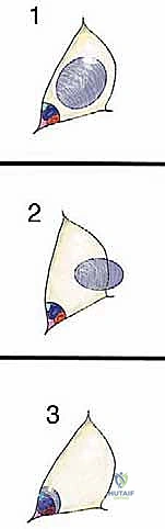 أعراض أورام القناة الخياطية وتأثيرها على الأعصاب