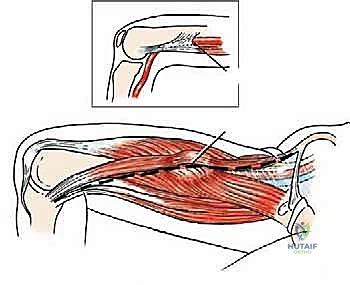 صورة توضيحية لـ استئصال ورم القناة الخياطية: دليل شامل لإنقاذ الأطراف مع الأستاذ الدكتور محمد هطيف في صنعاء