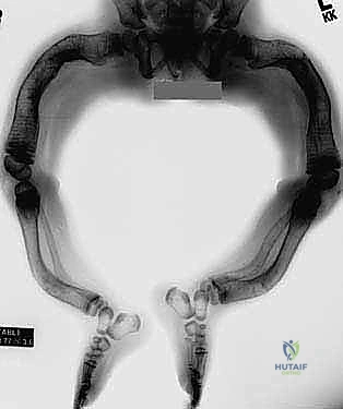 تأثير نقص الكولاجين على قوة العظام