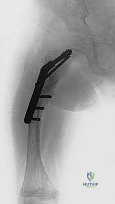 تطور التقوس في العظام الطويلة لدى الأطفال