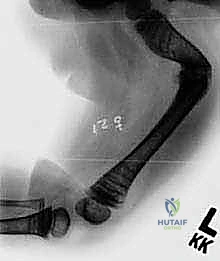 فحص سريري لحالة تخلّق العظم الناقص