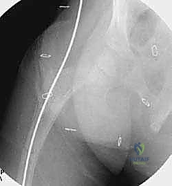 رؤى بعد التعافي الكامل من الجراحة