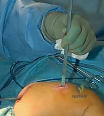 إجراء بضع العظم عبر الجلد بأدوات دقيقة