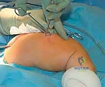 استقامة العظم بعد إجراء القطع المتعدد