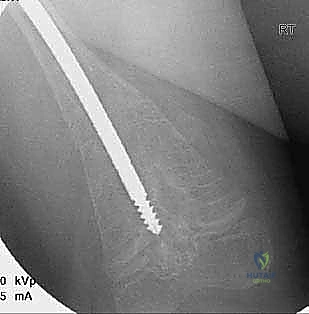 عمار يمارس حياته الطبيعية بعد الجراحة