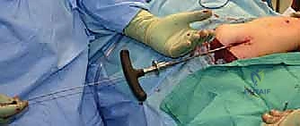 إدخال الجزء السفلي من المسمار التلسكوبي