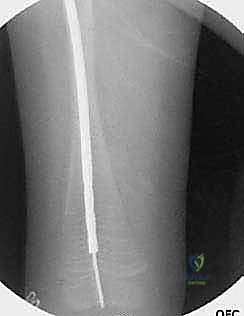 تأكيد التثبيت النهائي للمسمار بالأشعة