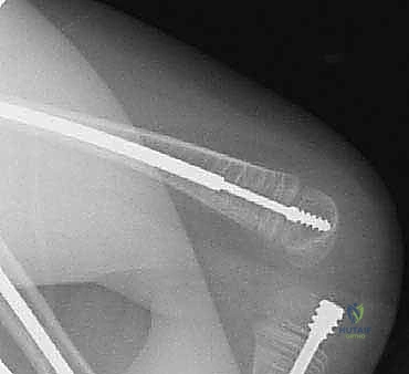 صورة توضيحية لـ علاج تشوهات العظام الطويلة لدى الأطفال المصابين بتخلّق العظم الناقص: تقنية بضع العظم عبر الجلد والمسامير التلسكوبية (فاسييه-دوفال)