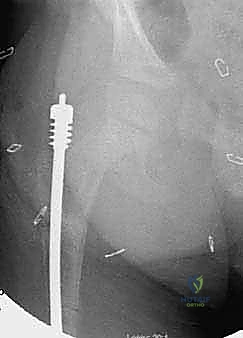 متابعة التئام العظم بالأشعة السينية
