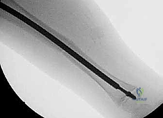 وضع الجبيرة الواقية للساق