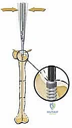 صورة توضيحية لـ علاج تشوهات العظام الطويلة لدى الأطفال المصابين بتخلّق العظم الناقص: تقنية بضع العظم عبر الجلد والمسامير التلسكوبية (فاسييه-دوفال)