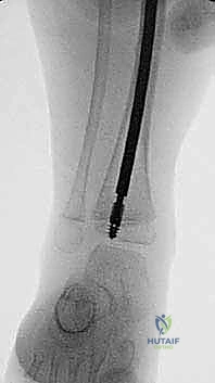 جلسات العلاج الطبيعي بعد الجراحة