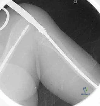 صورة توضيحية لـ علاج تشوهات العظام الطويلة لدى الأطفال المصابين بتخلّق العظم الناقص: تقنية بضع العظم عبر الجلد والمسامير التلسكوبية (فاسييه-دوفال)