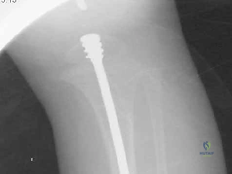 الطفل يبدأ في تحمل الوزن تدريجياً