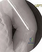 العمر المناسب لإجراء جراحة العظام الزجاجية