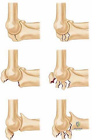 Olecranon Fracture Fixation: An Intraoperative Masterclass in Open Reduction Techniques