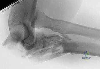 صورة طبية: كسور الناتئ المرفقي: دليل شامل للعلاج الجراحي واستعادة وظيفة المرفق مع الأستاذ الدكتور محمد هطيف