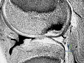 صورة توضيحية لـ ترقيع الغضروف العظمي الذاتي: استعادة الحياة لمفصل الركبة مع الأستاذ الدكتور محمد هطيف