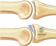 الأعراض السريرية والتشوه في مفصل PIP