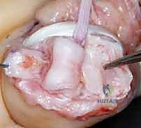 خطوات تحرير المفصل والأربطة