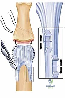 صورة توضيحية لـ رأب المفصل بالصفيحة الراحية: استعادة وظيفة مفصل PIP بعد الإصابات المزمنة