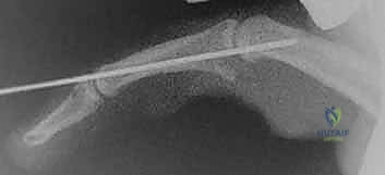 صورة توضيحية لـ رأب المفصل بالصفيحة الراحية: استعادة وظيفة مفصل PIP بعد الإصابات المزمنة