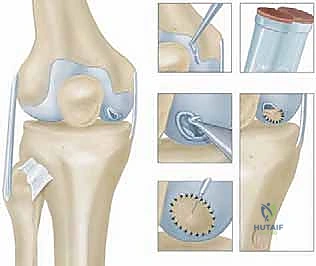 صورة توضيحية لـ زرع الخلايا الغضروفية الذاتية ACI: استعادة غضروف الركبة بدقة وفعالية مع الأستاذ الدكتور محمد هطيف