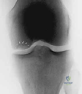صورة طبية: زرع الخلايا الغضروفية الذاتية ACI: استعادة غضروف الركبة بدقة وفعالية مع الأستاذ الدكتور محمد هطيف