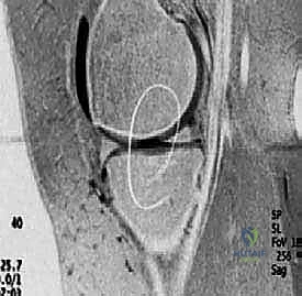 صورة طبية: زرع الخلايا الغضروفية الذاتية ACI: استعادة غضروف الركبة بدقة وفعالية مع الأستاذ الدكتور محمد هطيف