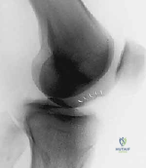 صورة طبية: زرع الخلايا الغضروفية الذاتية ACI: استعادة غضروف الركبة بدقة وفعالية مع الأستاذ الدكتور محمد هطيف