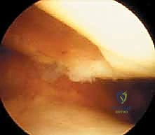 صورة طبية: زرع الخلايا الغضروفية الذاتية ACI: استعادة غضروف الركبة بدقة وفعالية مع الأستاذ الدكتور محمد هطيف