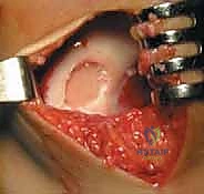 صورة طبية: زرع الخلايا الغضروفية الذاتية ACI: استعادة غضروف الركبة بدقة وفعالية مع الأستاذ الدكتور محمد هطيف