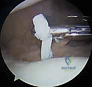 صورة طبية: زرع الخلايا الغضروفية الذاتية ACI: استعادة غضروف الركبة بدقة وفعالية مع الأستاذ الدكتور محمد هطيف