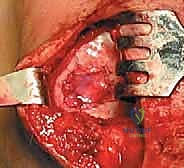 صورة توضيحية لـ زرع الخلايا الغضروفية الذاتية ACI: استعادة غضروف الركبة بدقة وفعالية مع الأستاذ الدكتور محمد هطيف