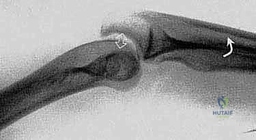 صورة توضيحية لـ خلع الكوع البسيط وإصلاح الرباط الجانبي الزندي الوحشي: دليل شامل للعلاج والتعافي