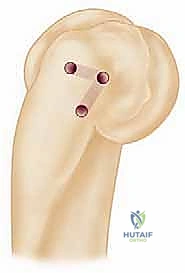 صورة توضيحية لـ خلع الكوع البسيط وإصلاح الرباط الجانبي الزندي الوحشي: دليل شامل للعلاج والتعافي