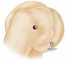 خطوات جراحة إصلاح الرباط الجانبي الزندي الوحشي