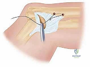 التصوير الشعاعي لخلع الكوع