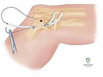 أعراض وتشوه الكوع المخلوع