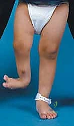 وصف طبي دقيق للمريض وتشوه القدم