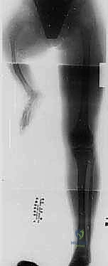 صورة طبية: عمليات بتر سيم وبويد الدقيقة لعلاج نقص عظم الشظية الخلقي: دليل شامل للمرضى