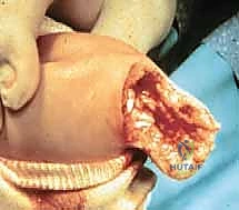 صورة طبية: عمليات بتر سيم وبويد الدقيقة لعلاج نقص عظم الشظية الخلقي: دليل شامل للمرضى