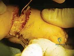 صورة توضيحية لـ عمليات بتر سيم وبويد الدقيقة لعلاج نقص عظم الشظية الخلقي: دليل شامل للمرضى