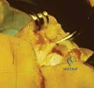 الشق الجراحي الدقيق وتحديد المعالم التشريحية